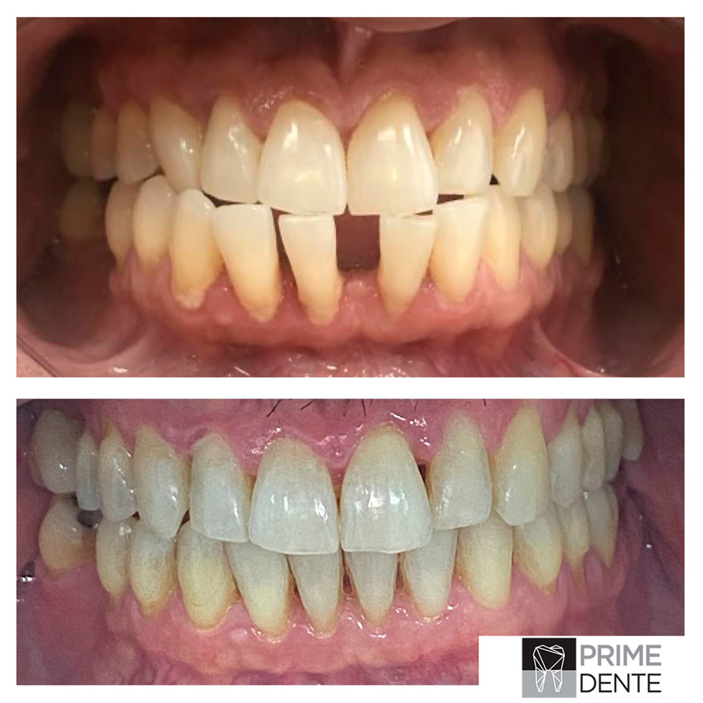 Invisalign Antes e Depois