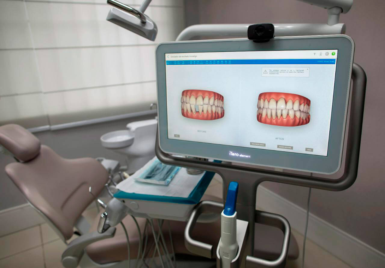 Itero, imegm de apareno tecnologica para leitura e escaneamento em 3d na clínica odontológica no méier e botafogo prime dente
